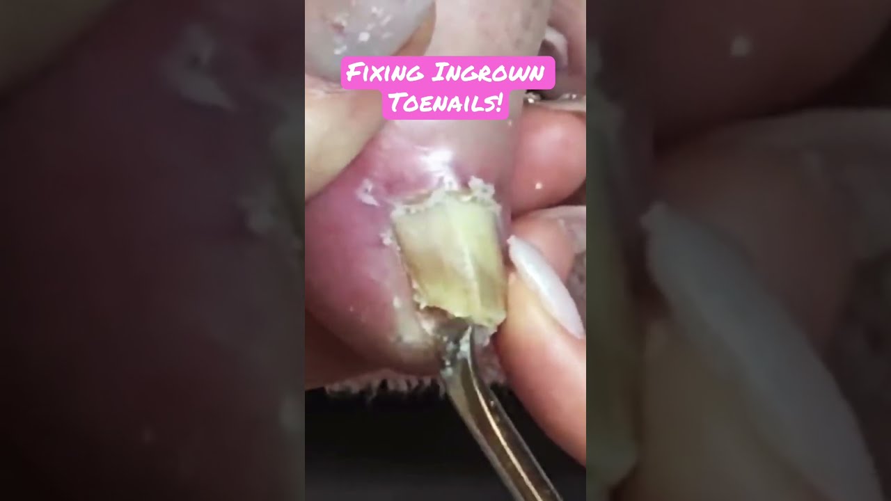 Ingrown Toenails Can Be Helped With A Pedicure Toenail Diypedicure