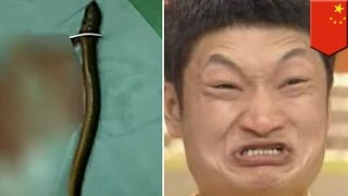 Pria memasukkan belut ke anus untuk menyembuhkan sembelit - Tomonews