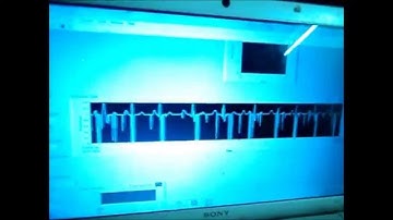 Live ECG Acquisition with Arduino and Labview : INA 114 IA with Arduino based Filtering