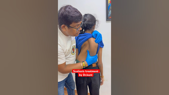 Scoliosis treatment #drrajneeshkant #worldfamouschiropractor