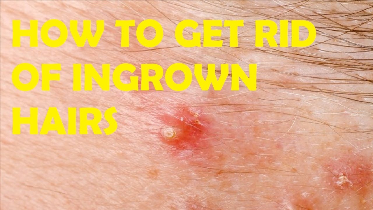 how to get rid of ingrown hairs and razor bumps in only 3 minutes YouTube