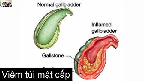 Viêm túi mật cấp: Nguyên nhân, cơ chế bệnh sinh, chẩn đoán Osmosis