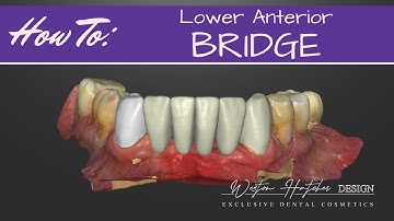 How To: Design a lower anterior bridge
