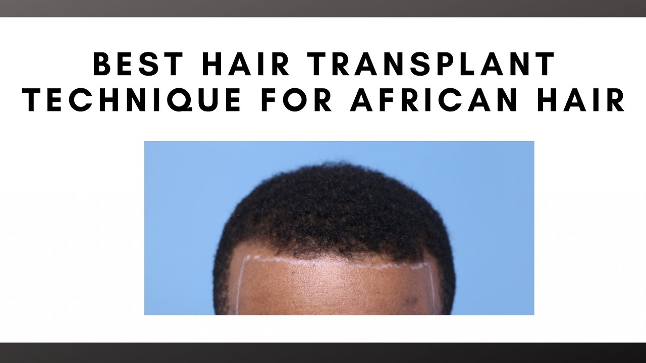 Best Hair Transplant Technique for African American Hair