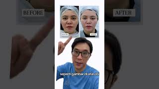 3 Things You Need To Know Before Doing Thread Implantation