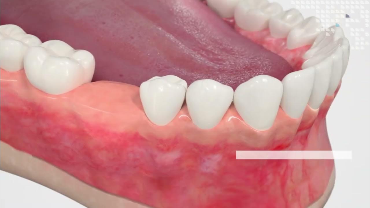ZimVie TSX Implant from Zimmer Dental Tradition YouTube