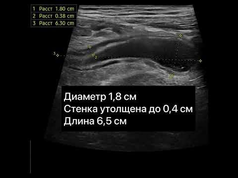 Острый аппендицит на УЗИ