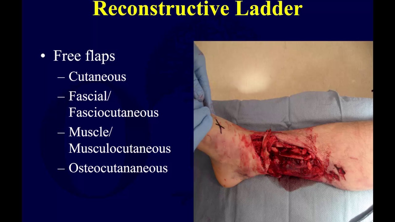Wound Coverage Techniques 1 Skin Grafts Ota Lecture Series Iii G14a Youtube