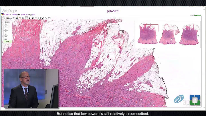 Pathology Insights: Challenging Cutaneous Spindle ...