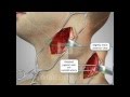 Medical animation  carotid endarterectomy approach