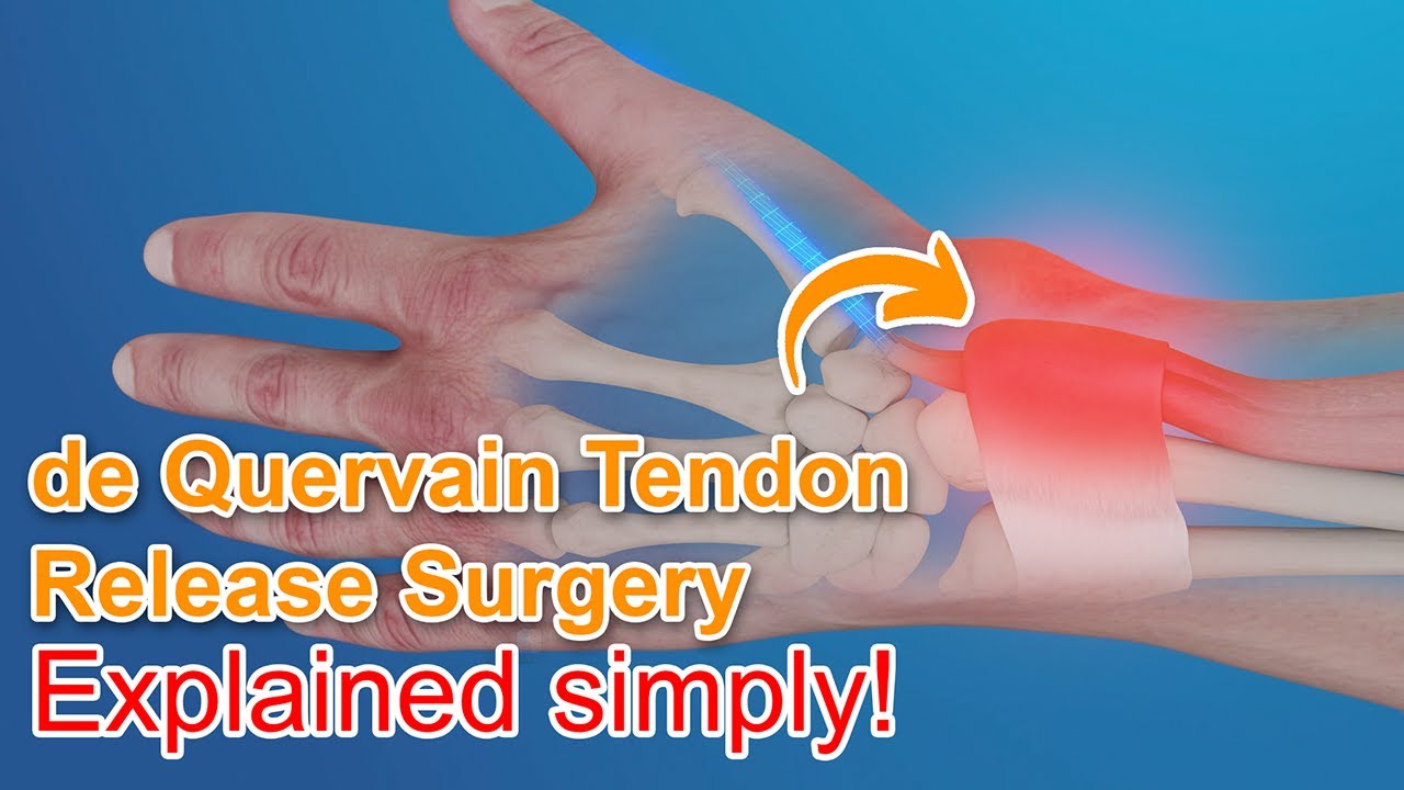 Hand Surgery For De Quervain S Tenosynovitis The Best Porn Website