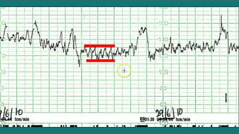 Ctg interpretation - Normal CTG