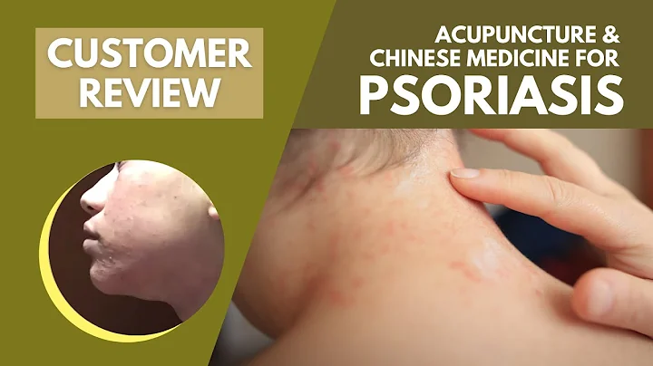 Acupuncture and Traditional Chinese Medicine for Psoriasis | Psoriasis Removal Treatment | GinSen - DayDayNews