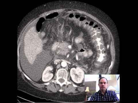 CT Abdomen and Pelvis Portal Vein Thrombosis DISCUSSION by radiologist