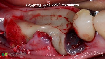 Titanium mesh technique for Ridge augmentation and Implant placement
