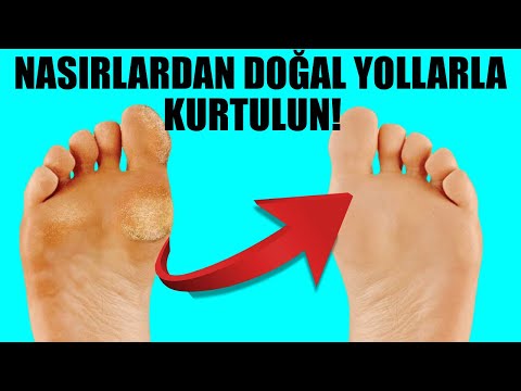 Nasırlardan Doğal Yollarla Kurtulma Kürleri