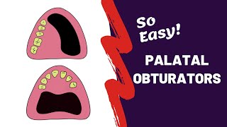PROSTHODONTICS | What is Palatal Obturator? screenshot 4