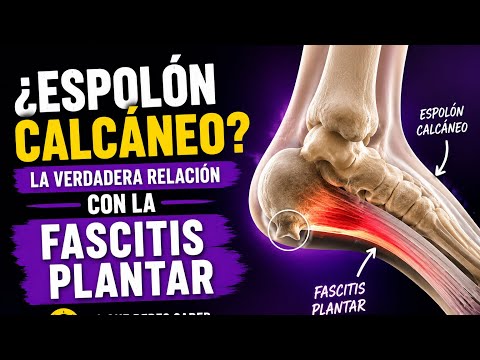 ¿El espolón calcáneo realmente duele? La verdad sobre la fascitis plantar