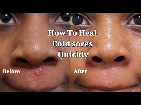 How to heal Cold sores quickly - Fast recovery + realistic way to treat breakouts (Baby powder)