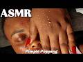ASMR | PIMPLE POPPING BABYSIS FACE | #asmr #pimplepopping #nitpicking #viral #relaxing #pimple