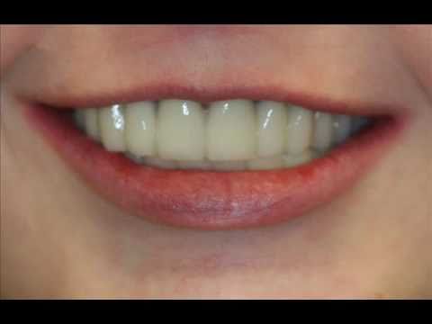 rigby-advanced-dental-ectodermal-dysplasia-implant-rehab