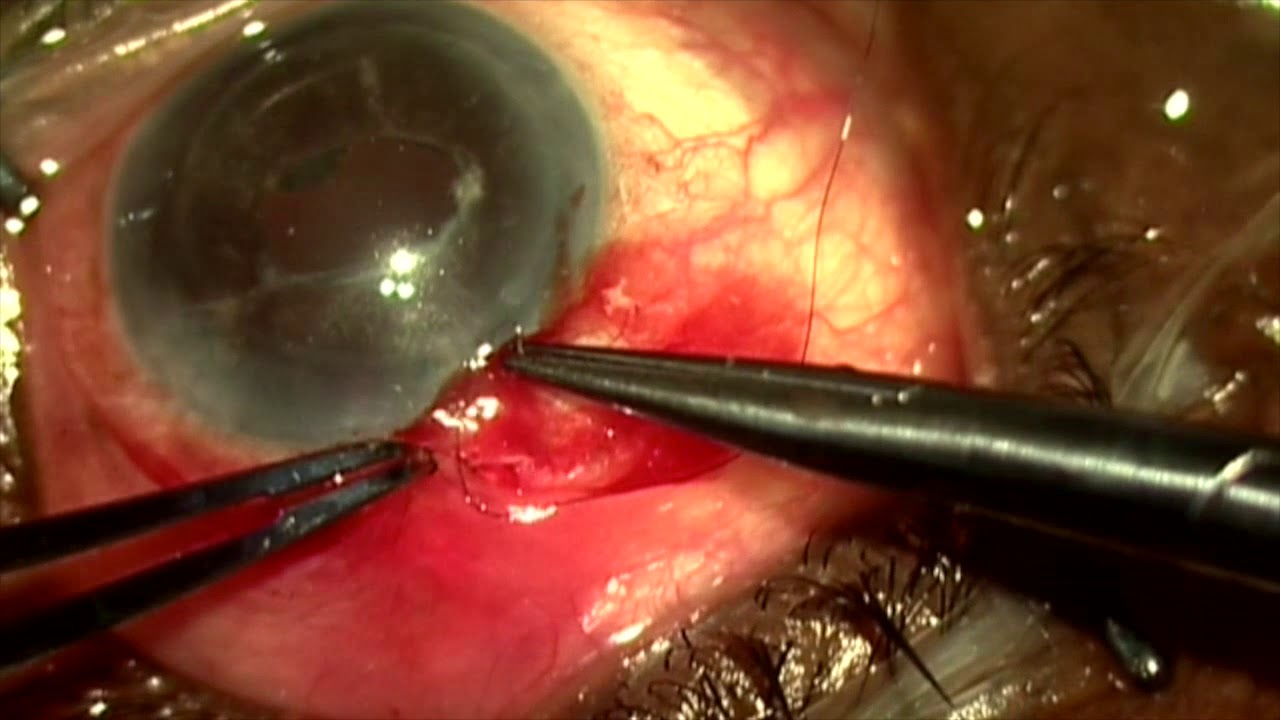 Xen ab externo open approach by Steven G. Safran MD