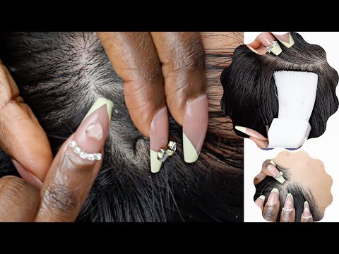 1HR Scalp Inspection | NITPICKING WHITEHEADS, brushing, blowing flakes | no talking | SUPER ZOOM