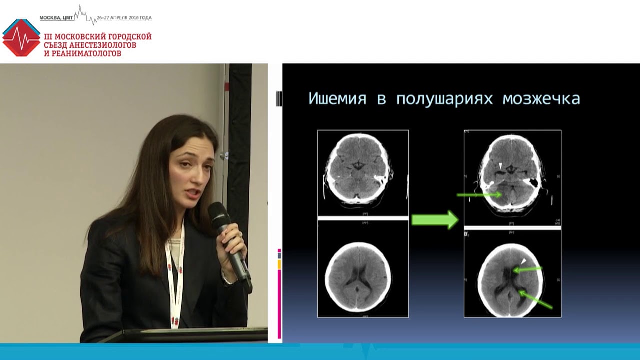 КТ и МРТ для выбора методов интенсивной терапии. Филимонова Е.В.
