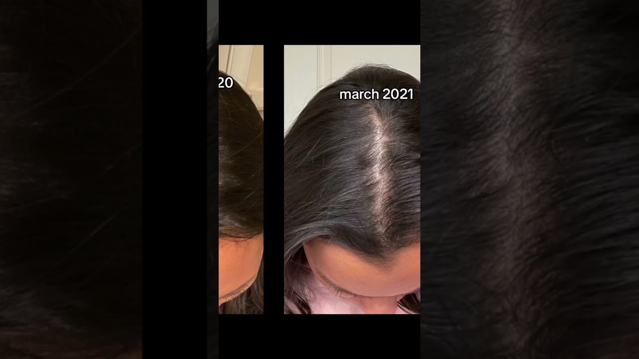 My Hair Loss Journey Stress Recovery