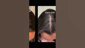 Thumbnail of my hair loss journey- stress hair loss recovery
