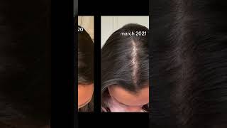 my hair loss journey- stress hair loss recovery