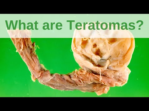 Video: Teratoma - Causes, Types, Symptoms In Adults And Children, Treatment