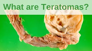 What are Teratomas? - Pathology mini tutorial