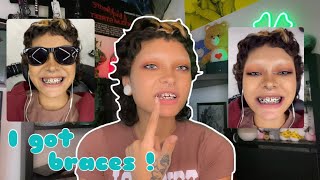 I Finally Got Braces Storytime My Experience