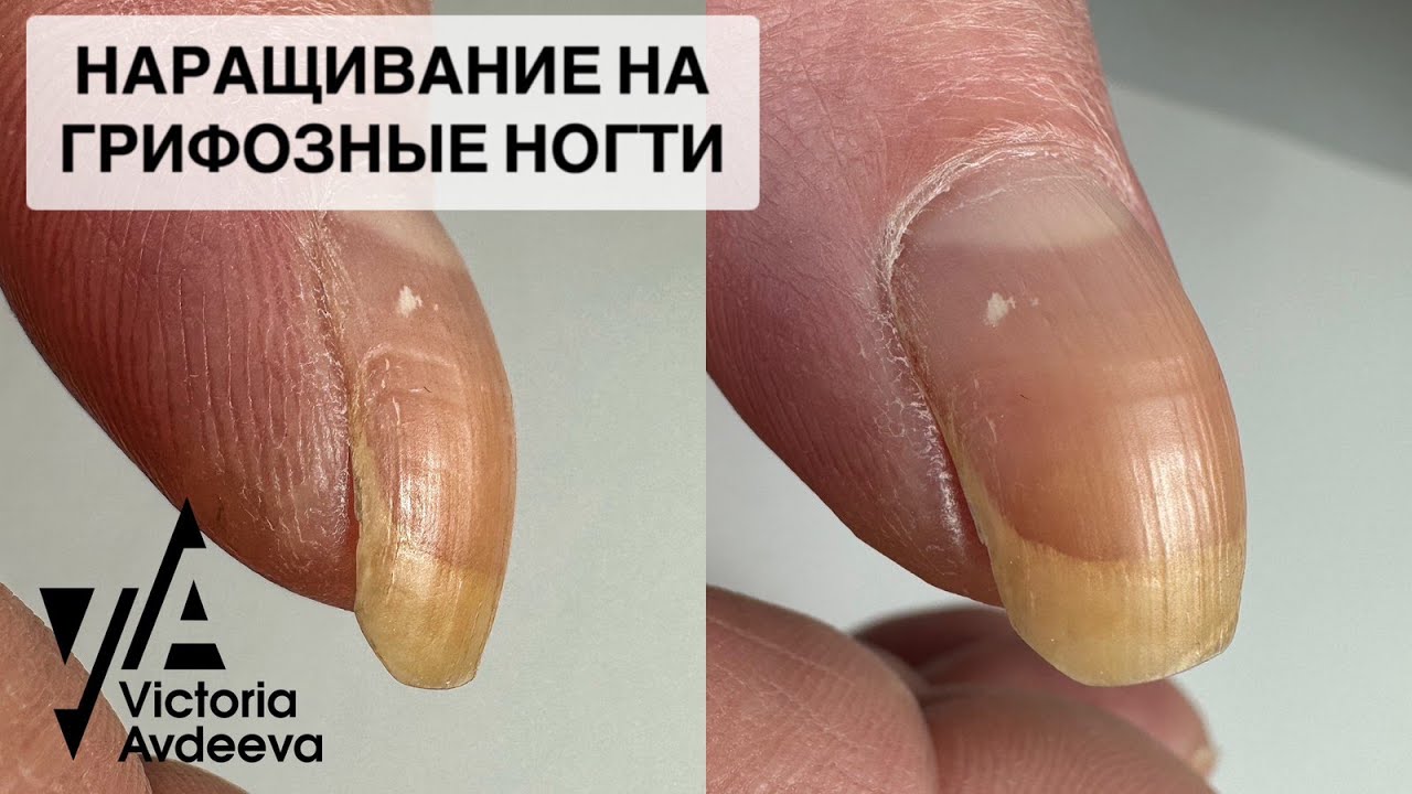 НАРАЩИВАНИЕ НА ГРИФОЗНЫЕ НОГТИ. МАНИКЮР ОНЛАЙН. Виктория Авдеева - YouTube