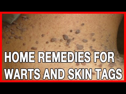 Home Remedies For Warts And Skin Tags On Hands, Neck And Armpits