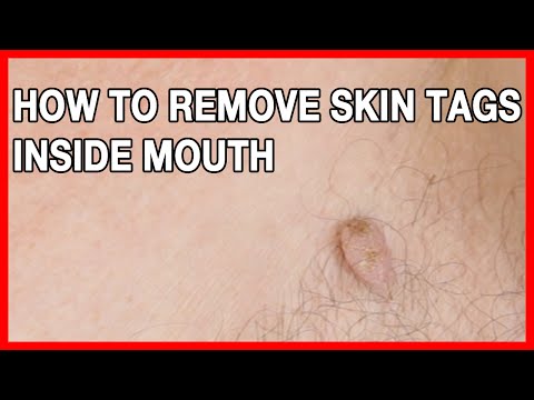 How To Eliminate Skin Tags Inside The Mouth