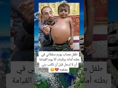 طفل مصاب بورم سلطاني في بطنه لاترحل قبل ان تكتب ربي يشفيه