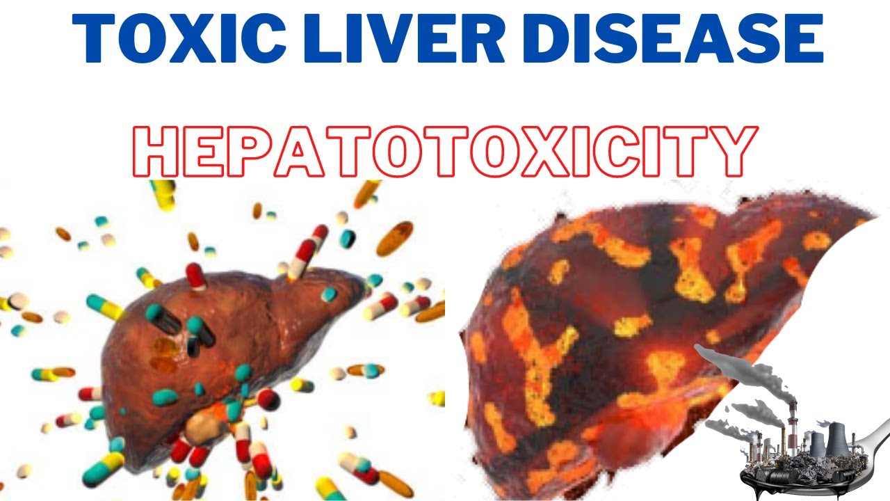 Toxic Liver Disease (Hepatotoxicity) How do you know if you have liver toxicity? 247nht