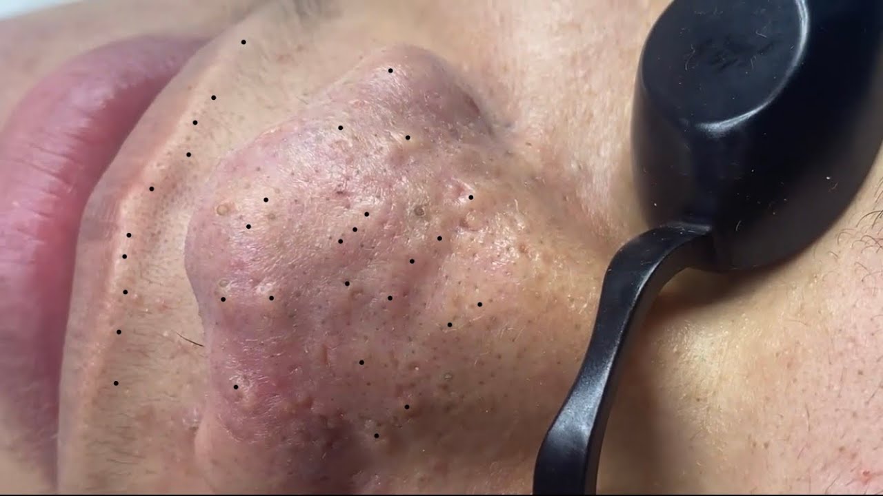 Extreme Blackhead Removal at NASA Skin Care #005