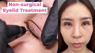 I Tried the Plasma Pen to Fix My Uneven Eyelids: BEFORE & AFTER by Tina Yong 430,050 views 4 months ago 12 minutes, 39 seconds