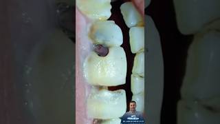 حشو كمبوزيت ||composite restoration of anterior teeth