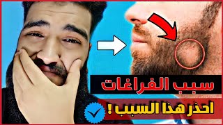 انبات فراغات اللحية وأسباب وجود الفراغات - تخلص منها الان !