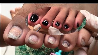 pedicure cleaning dryskin removal