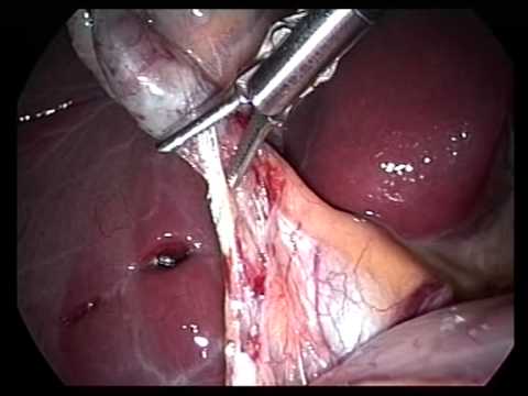 Laparoscopic Videos (edited-8)- Lap Chole In Pregnancy 14 Weeks