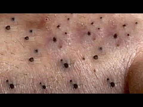 Blackheads Removal Big Acne blackheads Extraction Whiteheads