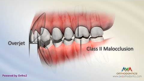 Malocclusion - Class II End On