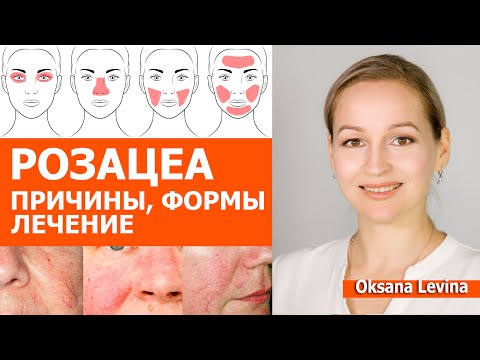 РОЗАЦЕА. Почему появляется, какая бывает и как лечить