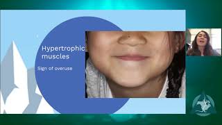 Aaop 2021 Temporomandibular Disorders In The Pediatric Adolescent Population Cristina Perez
