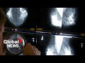 Breast cancer screening decision sparks review of Canada&#39;s task force